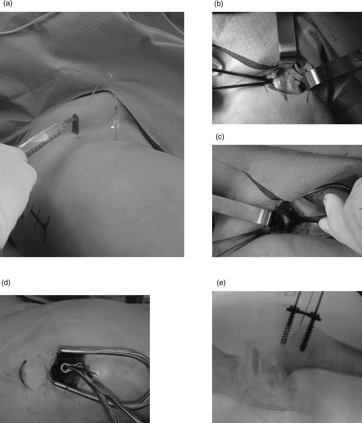 Perthes disease: comparison of two surgical options