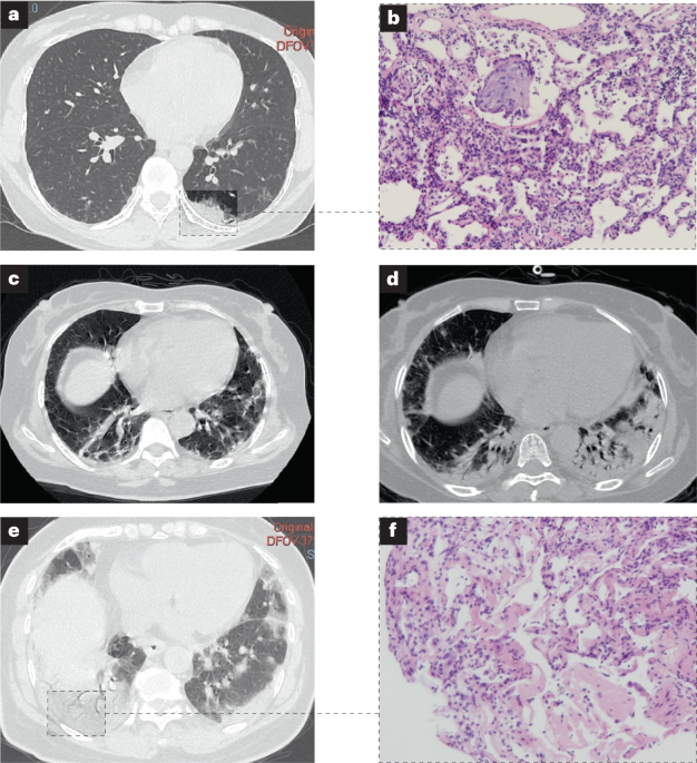 Anti-MDA5 antibody-positive dermatomyositis: pathogenesis and clinical progress