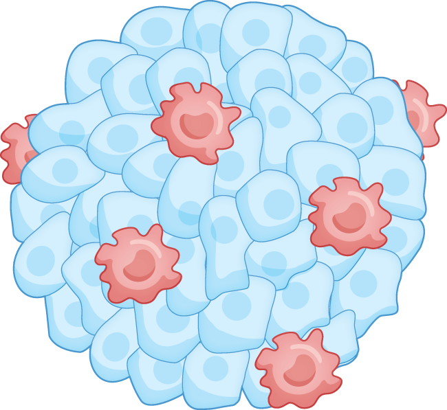 Tumour-associated macrophages and pancreatic cancer: an inflammatory loop