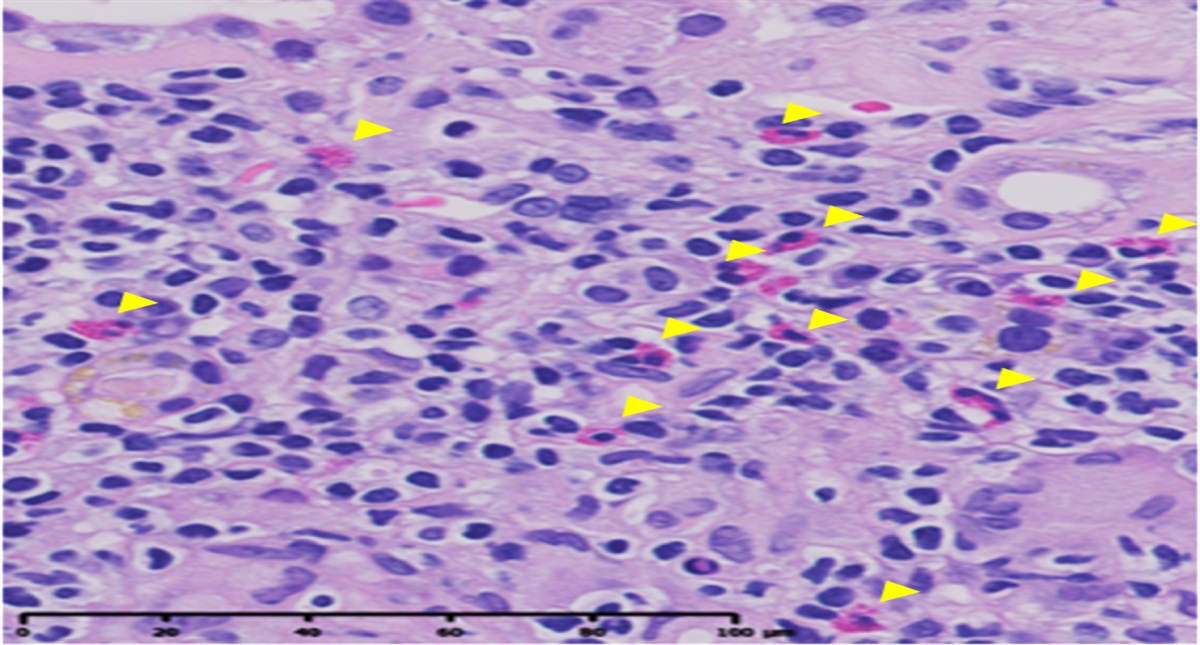 Interstitial Eosinophilic Aggregates and Kidney Outcome in Patients with CKD