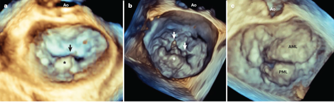 Degenerative mitral regurgitation