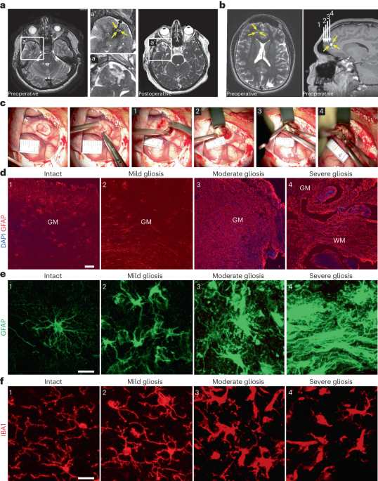 Injury-specific factors in the cerebrospinal fluid regulate astrocyte plasticity in the human brain