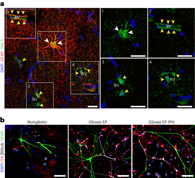 Injury-specific signals elicit plasticity in glial cells from patients with brain injury
