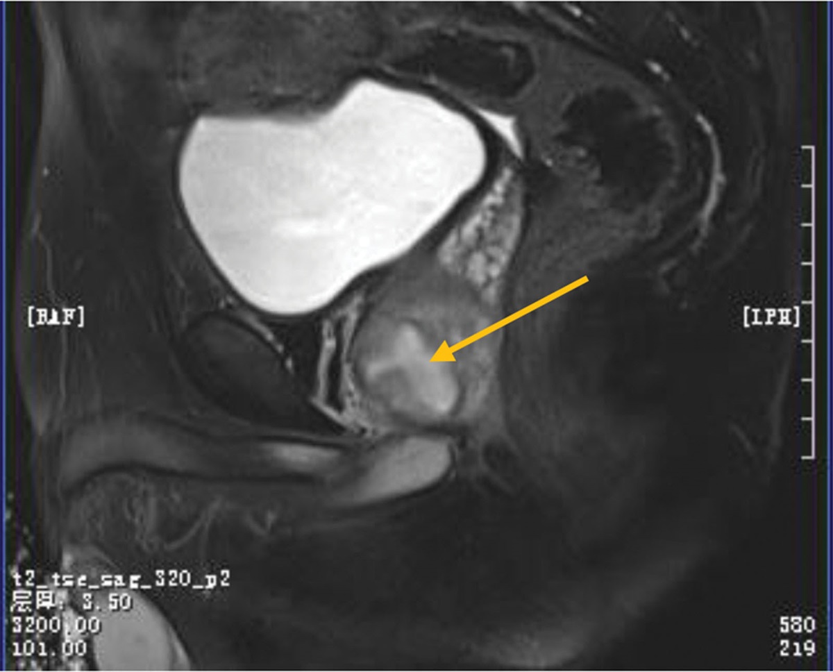 Prostatic abscess due to carbapenem-resistant K. pneumonia: A case report
