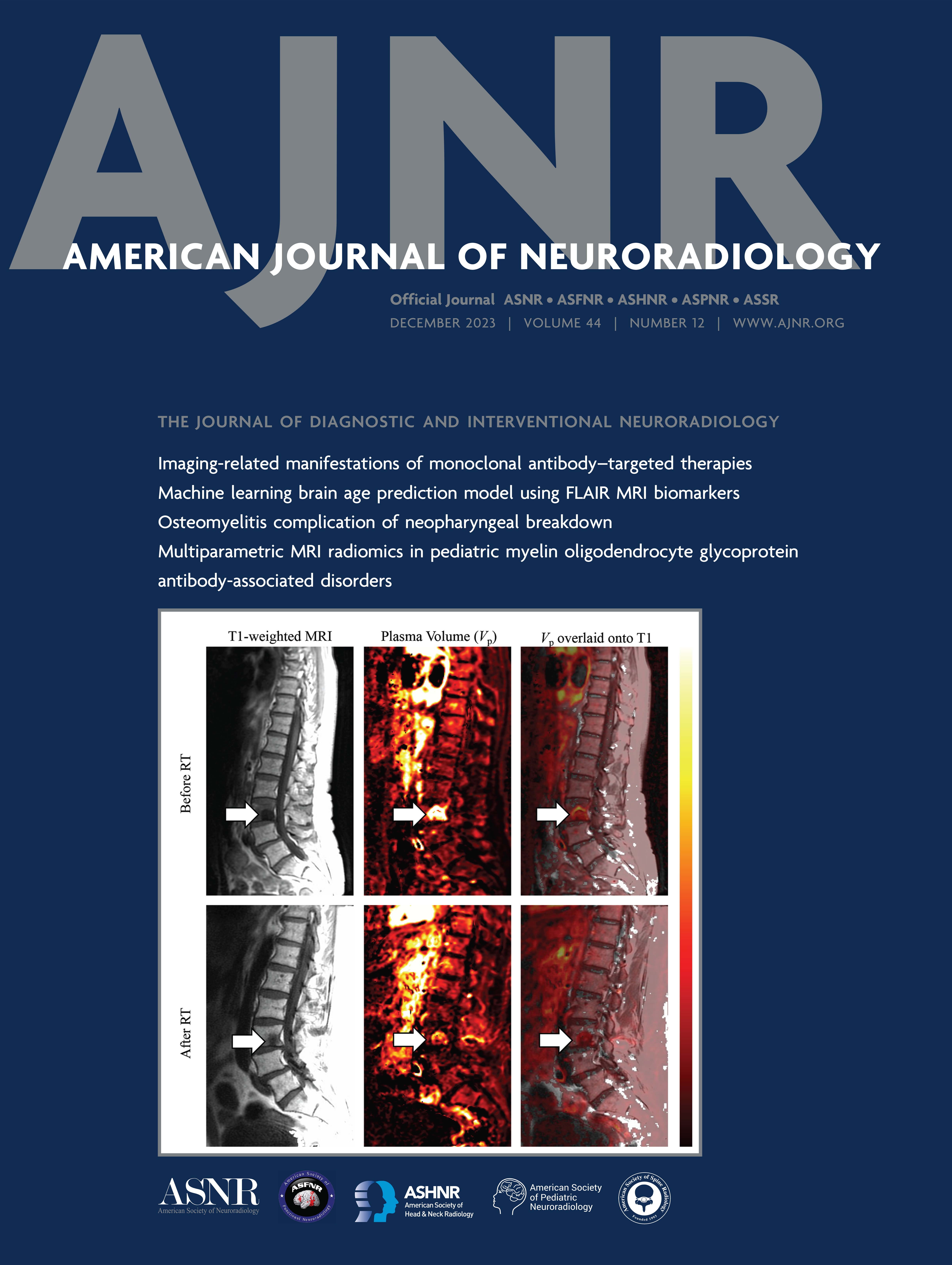 Quantification of Thalamic Atrophy in MS: From the Multicenter Italian Neuroimaging Network Initiative Data Set to Clinical Application [ULTRA-HIGH-FIELD MRI/IMAGING OF EPILEPSY/DEMYELINATING DISEASES/INFLAMMATION/INFECTION]