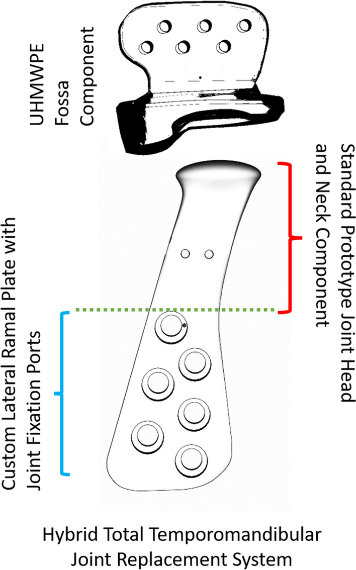 Hybrid total alloplastic temporomandibular joint replacement prosthesis: a pilot study to evaluate feasibility, functional performance and impact on post-operative quality of life