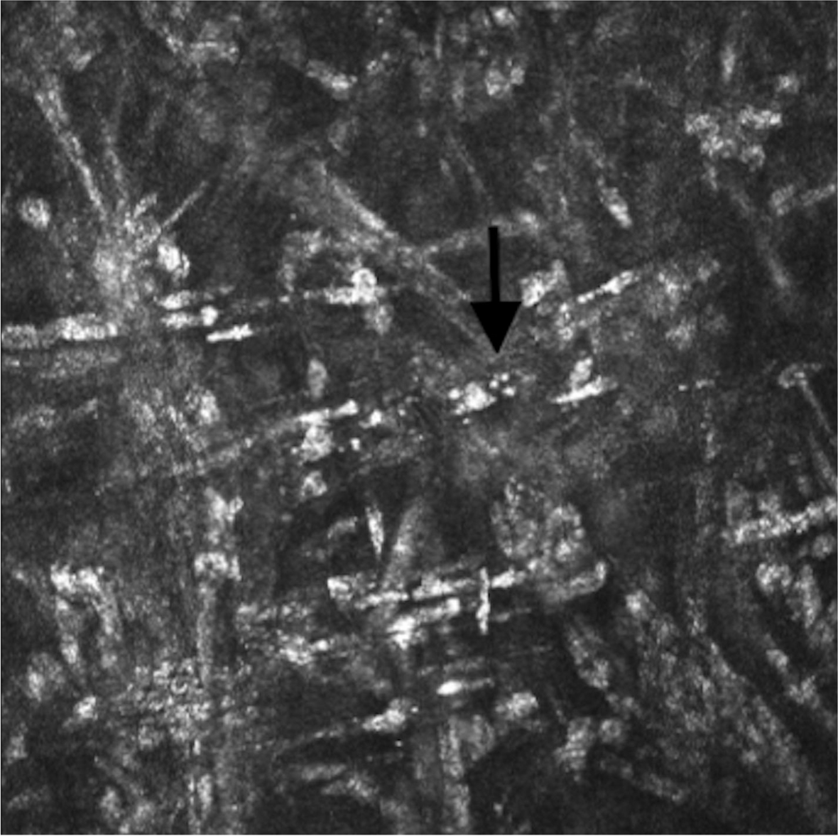 Three cases of recalcitrant Paecilomyces keratitis in Southern California within a short period