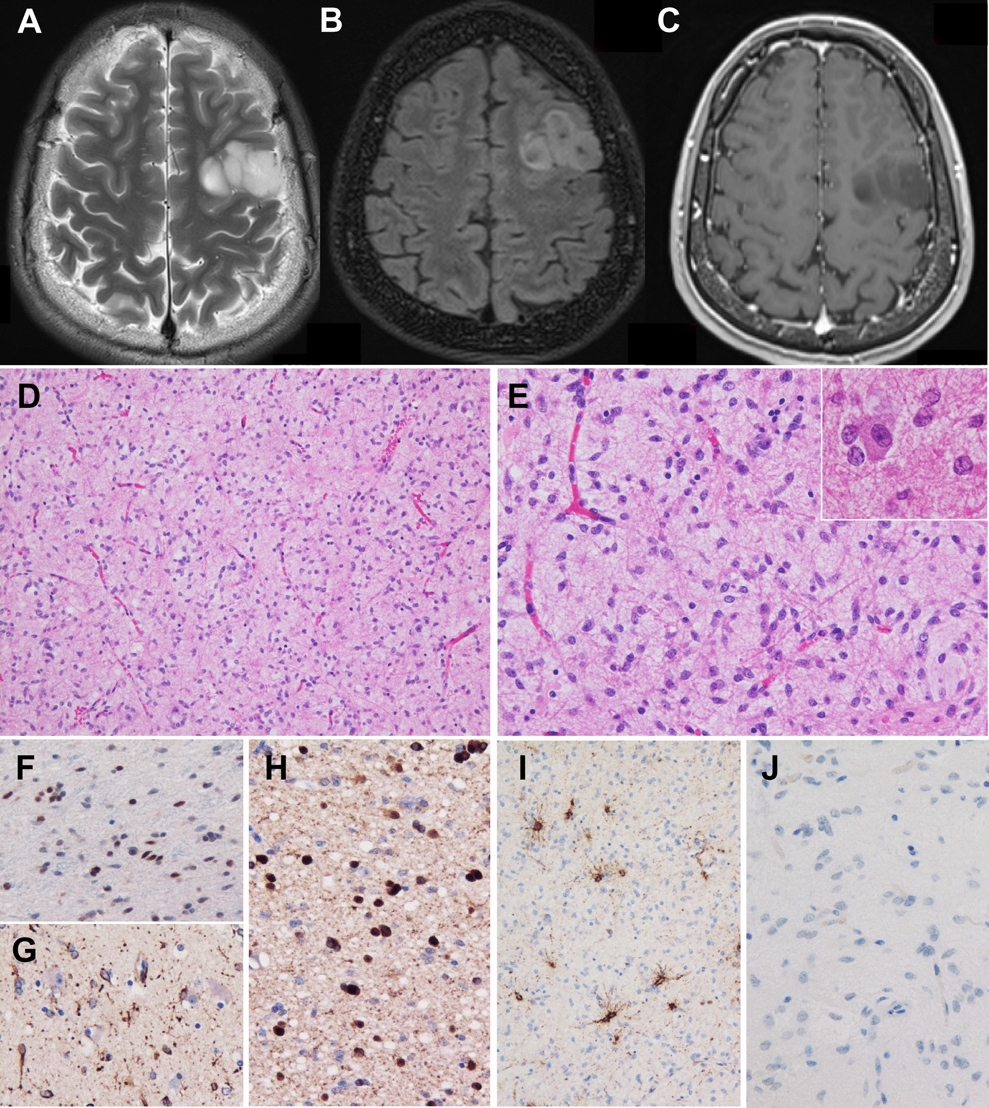 Pediatric diffuse glioma with EP300::BCOR fusion manifesting as low-grade epilepsy-associated neuroepithelial tumor: a case presentation