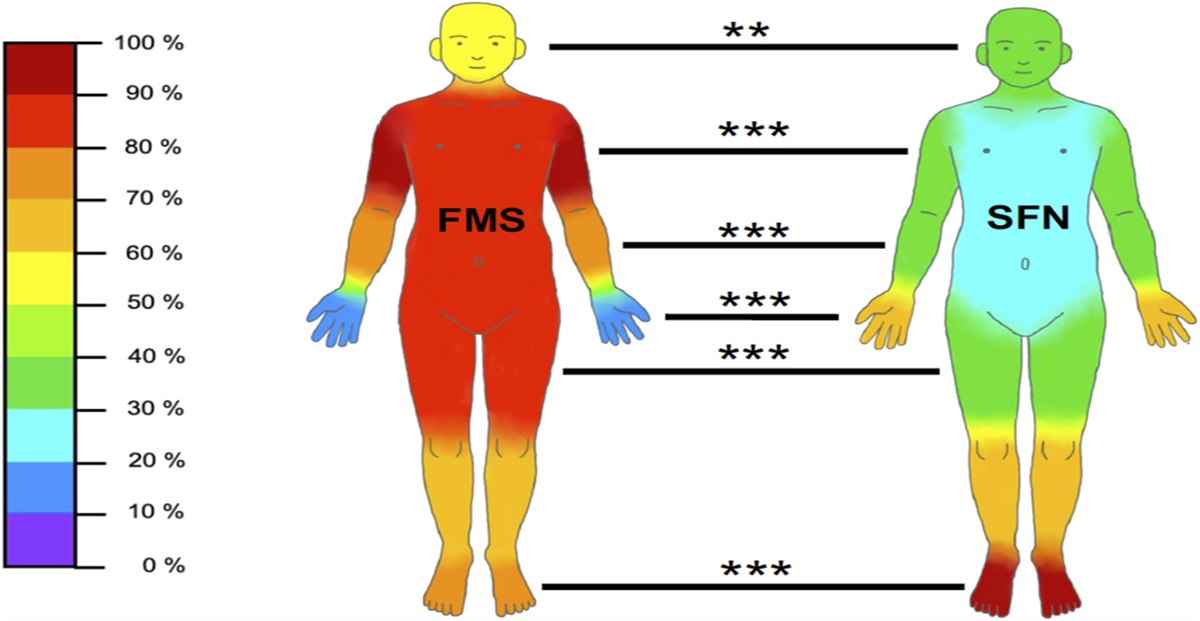Distinguishing fibromyalgia syndrome from small fiber neuropathy: a clinical guide