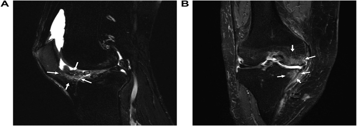 Pathology of knee osteoarthritis pain: contribution of joint structural changes and pain sensitization to movement-evoked pain in knee osteoarthritis
