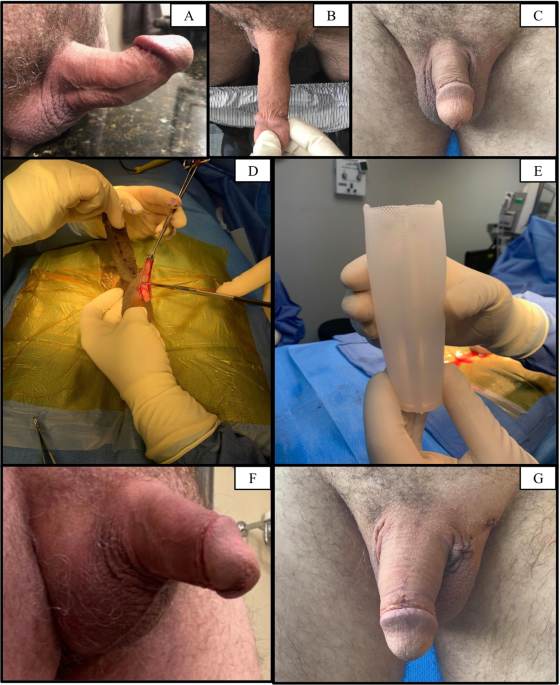 Use of Himplant® for correction of residual deformity following prior treatment of peyronie’s disease: a case series