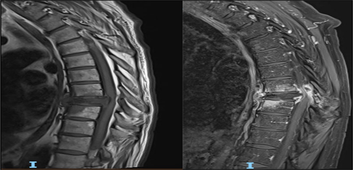 Basal Cell Carcinoma With Metastasis to the Thoracic Spine: An Uncommon Case Report and Review of the Literature
