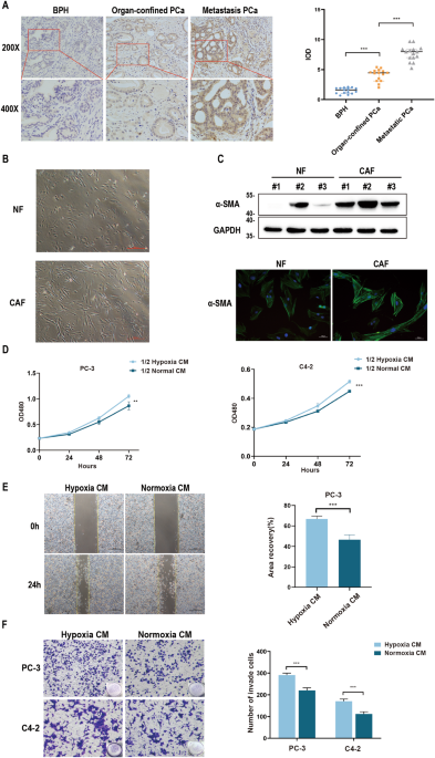 Cancer-associated fibroblast exosomes promote prostate cancer metastasis through miR-500a-3p/FBXW7/HSF1 axis under hypoxic microenvironment