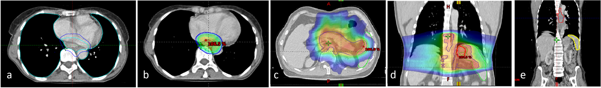 Platelet-to-albumin ratio and radiation-induced lymphopenia—prognostic biomarker for carcinoma esophagus