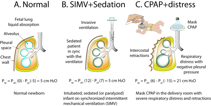 Pneumothorax in a term newborn