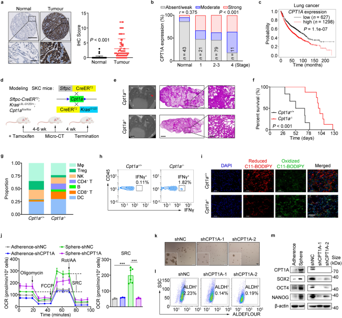 Targeting carnitine palmitoyl transferase 1A (CPT1A) induces ferroptosis and synergizes with immunotherapy in lung cancer