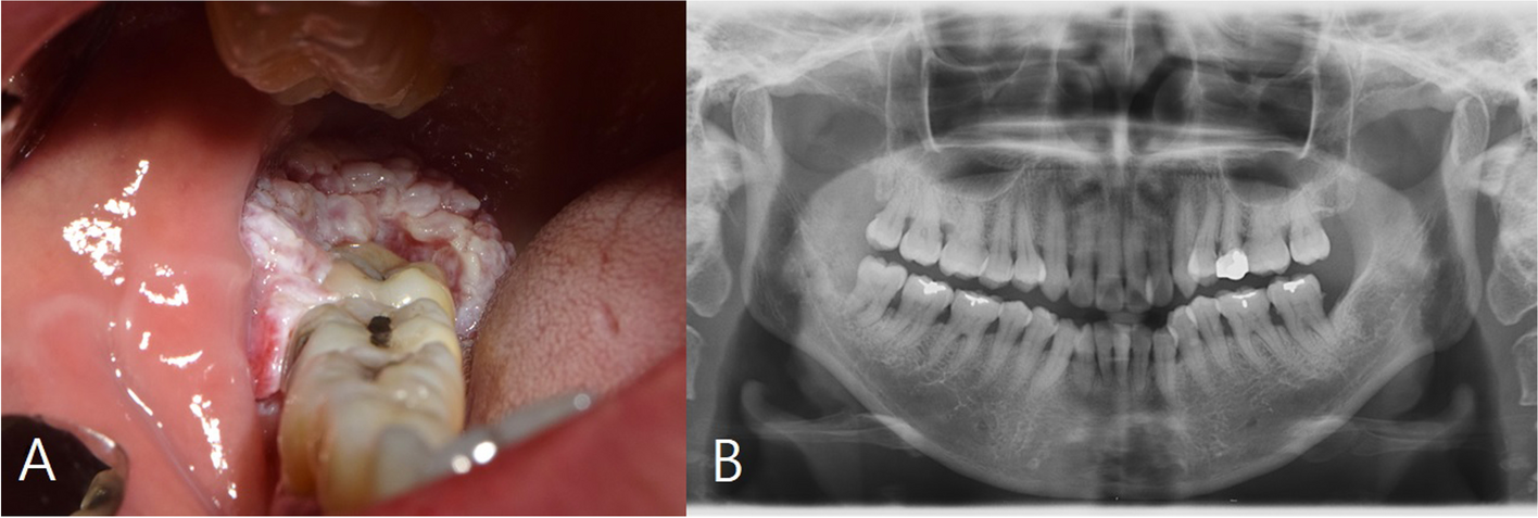 Fibular free flap with proximal perforator skin paddle due to aberrant anatomy — a case report