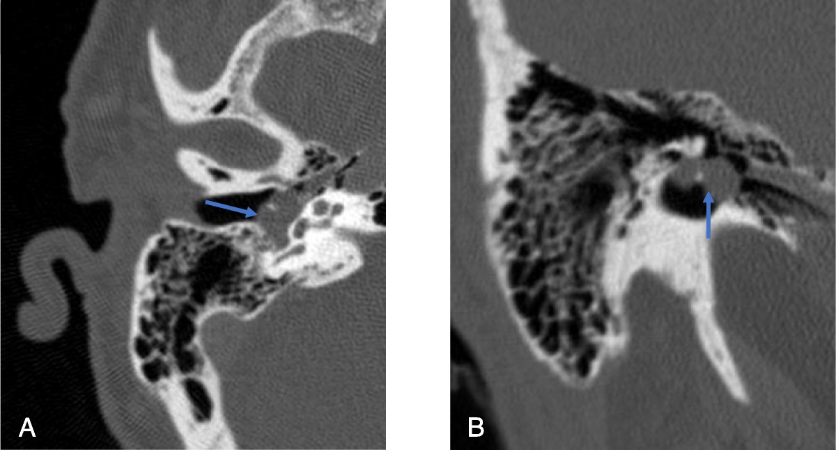 Chorda Tympani Schwannoma: A Rare Nerve Sheath Tumor of the Middle Ear Cleft