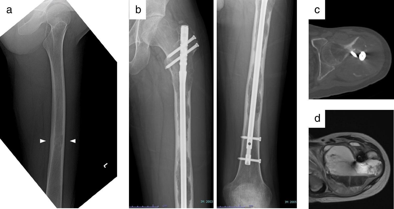 The diagnostic utility of cytology specimen in a case of EWSR1::NFATC2 sarcoma