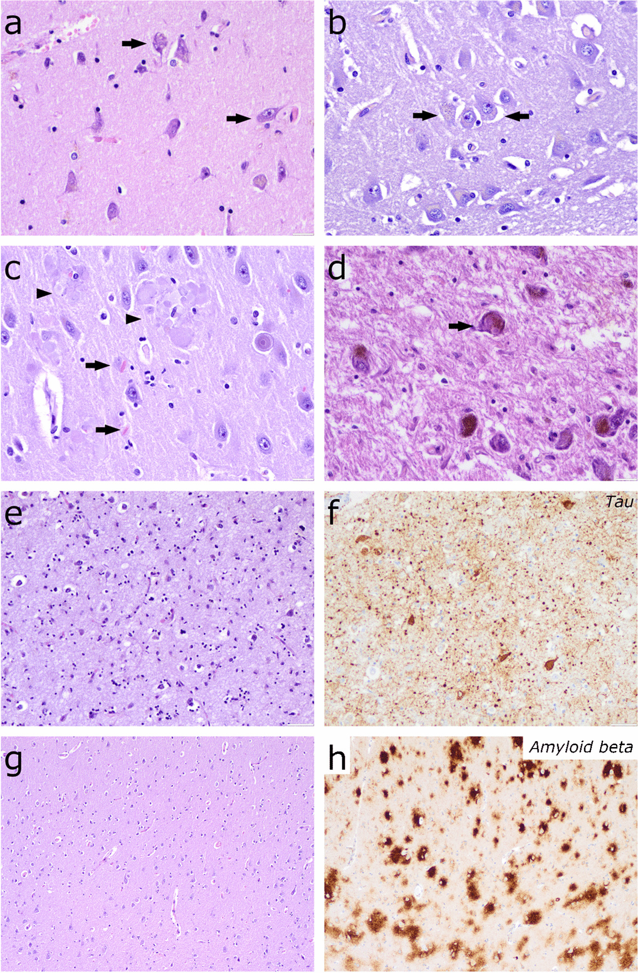 Flanagan’s condensed protocol for neurodegenerative diseases. Implementation in a clinical autopsy setting with partial supervision of a neuropathologist