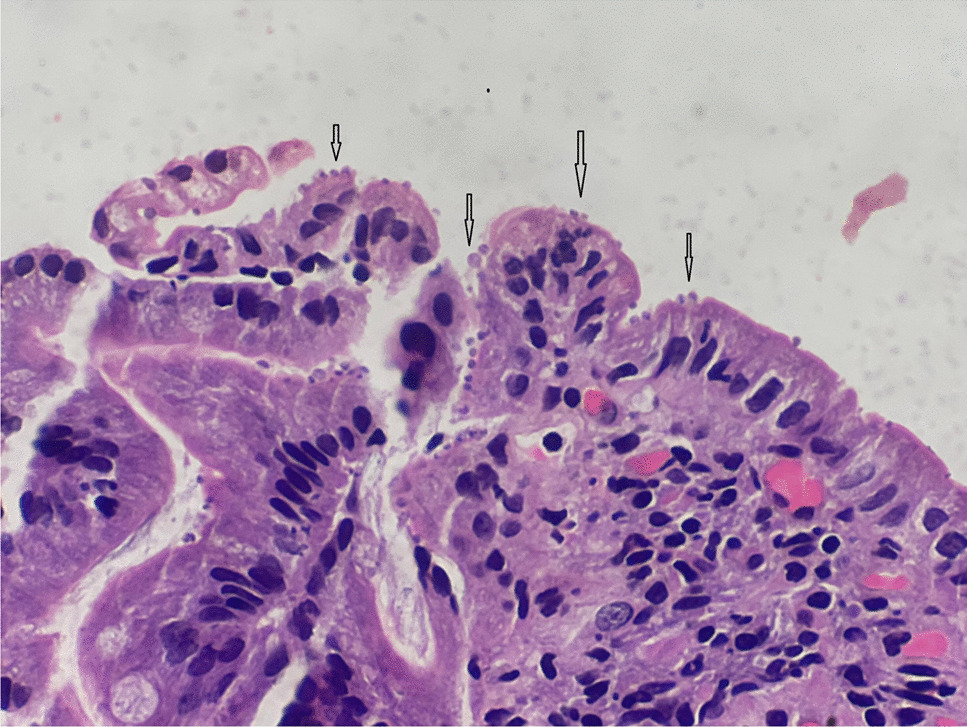 A rare cause for persistent ascites after liver transplantation