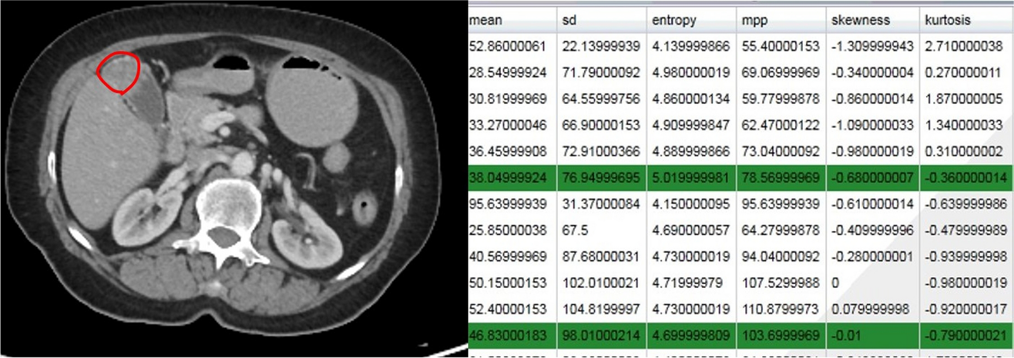 Applications of artificial intelligence in biliary tract cancers