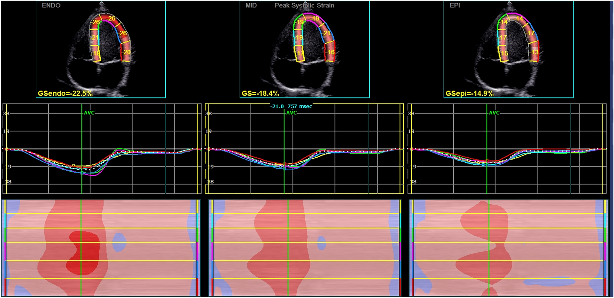 Evaluation of the Left Ventricular Myocardium Using Layer-Specific Strain Analysis in Adolescent Athletes Performing High-Intensity Interval Training