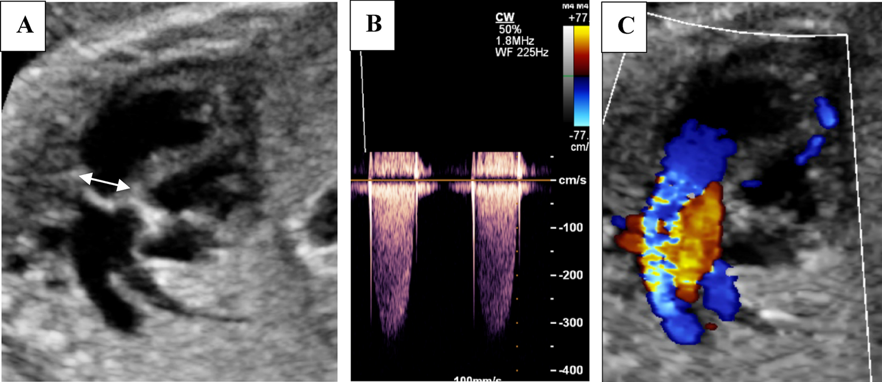 Prenatal Predictors for Pulmonary Balloon Valvuloplasty in the Newborn