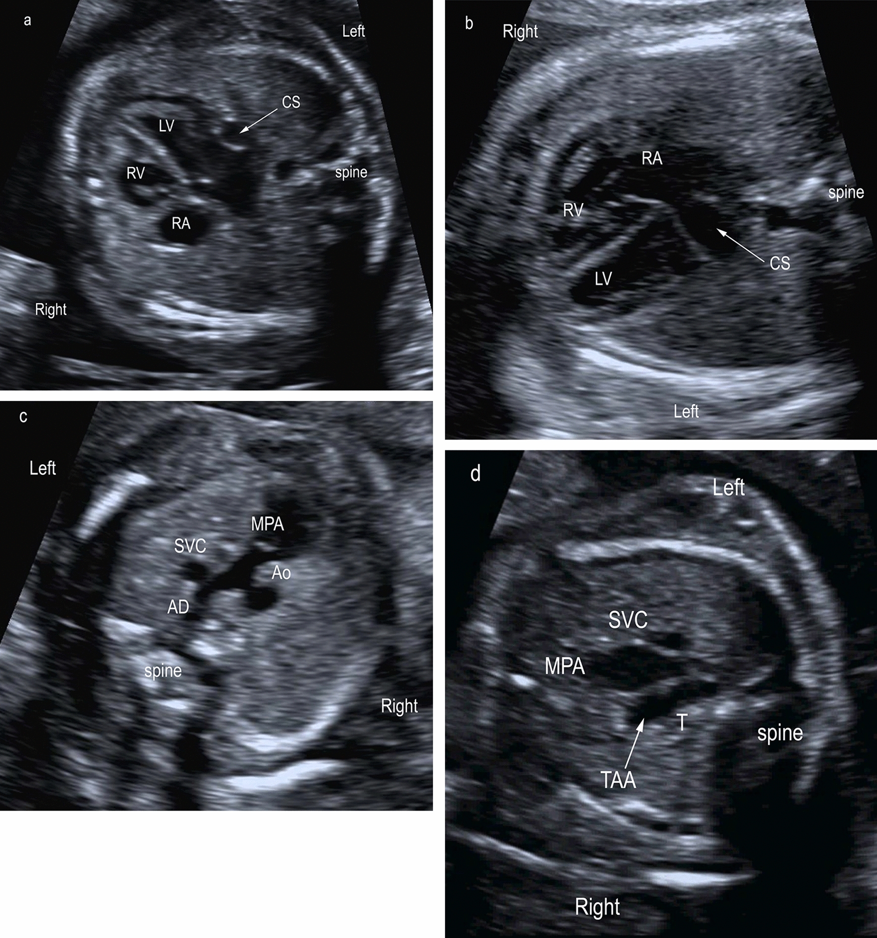 Association of Prenatally Diagnosed Isolated Single Left Superior Vena Cava and Postnatal Development of Coarctation of the Aorta