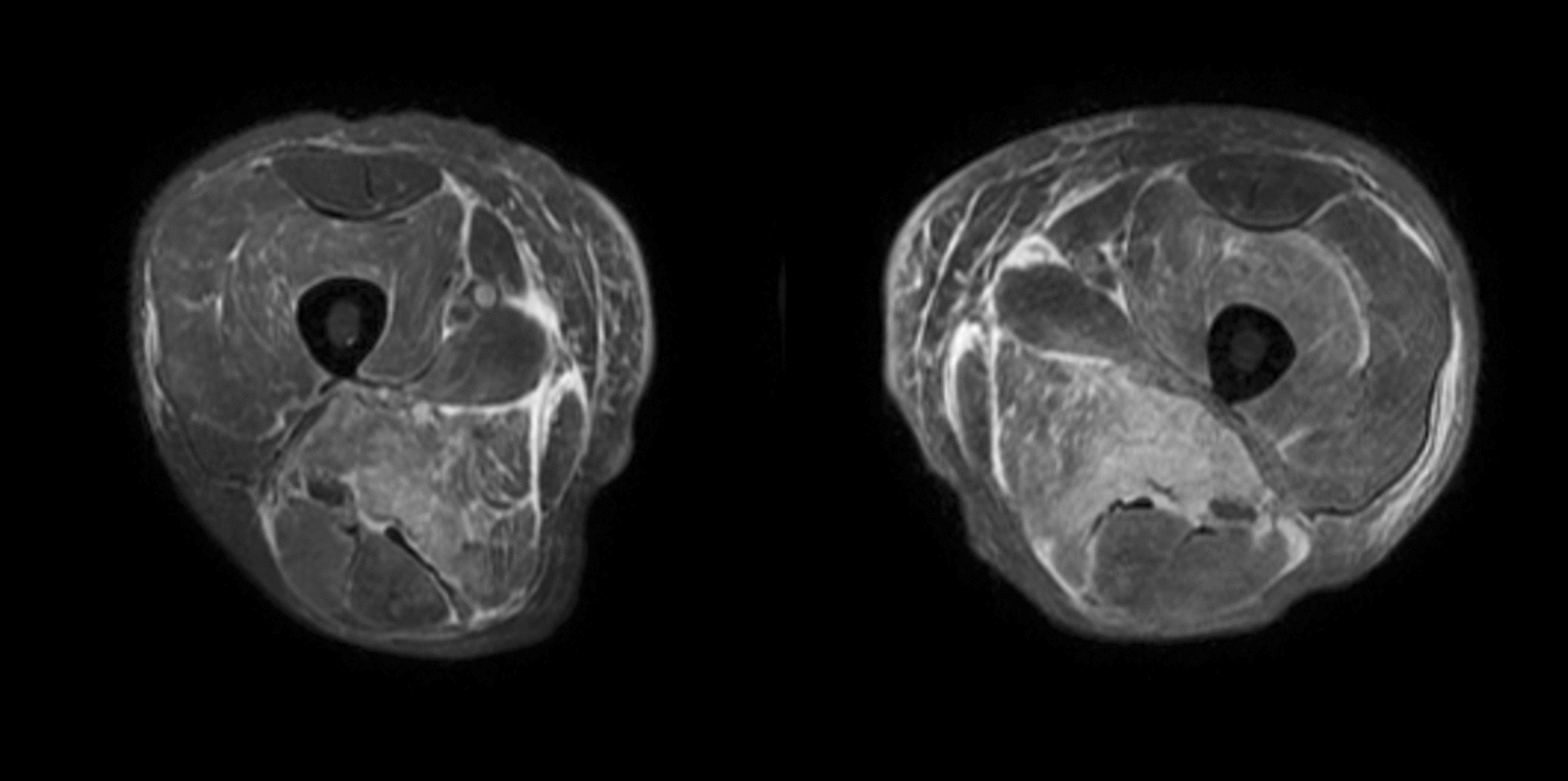 Statin-induced immune-mediated necrotizing myopathy with concomitant increase of anti-HMGCR and anti-ACHR antibodies