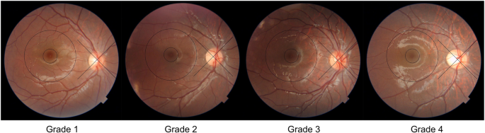 Tessellated fundus occurs earlier than myopia in children aged 3–6 years
