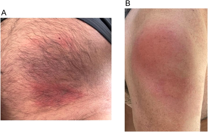 Ocular and orbital manifestations in VEXAS syndrome
