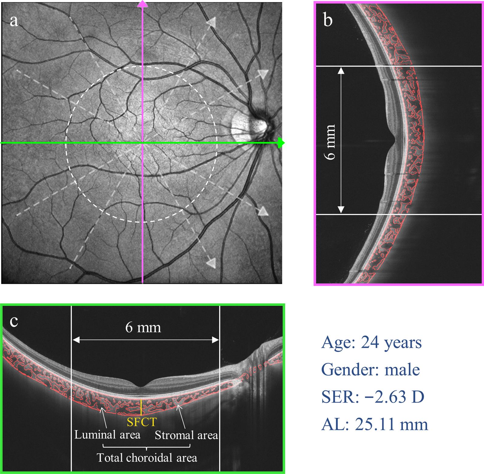 Differences in choroidal responses to near work between myopic children and young adults