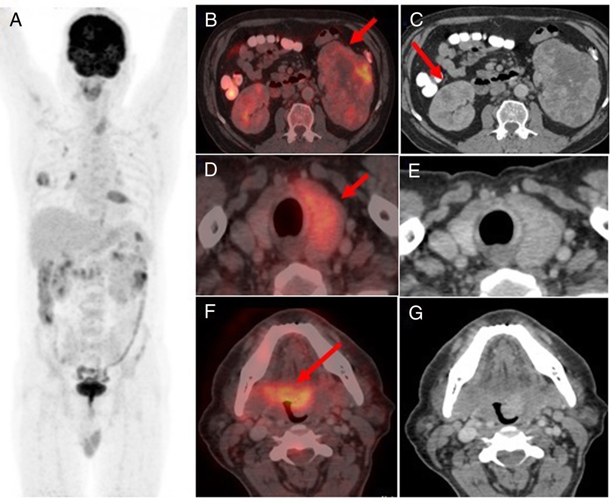 FDG PET/CT in the Diagnosis and After Sunitinib Follow-up of Synchronous Base of Tongue and Thyroid Metastases From Renal Cell Carcinoma