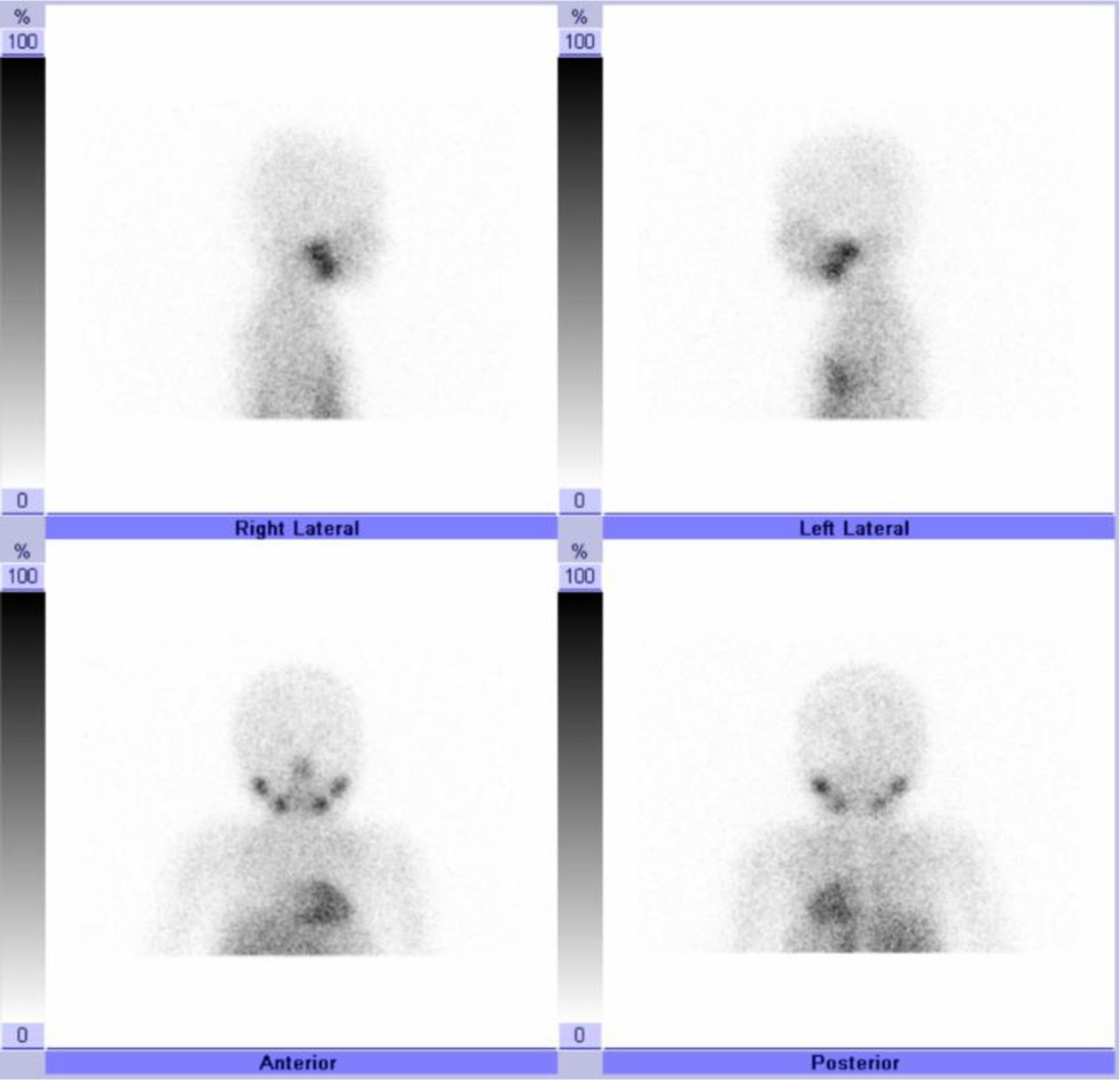 A Rare Case of Abnormal Diffuse Brain Uptake on an 123I MIBG Scan in a Patient With High-Risk Neuroblastoma