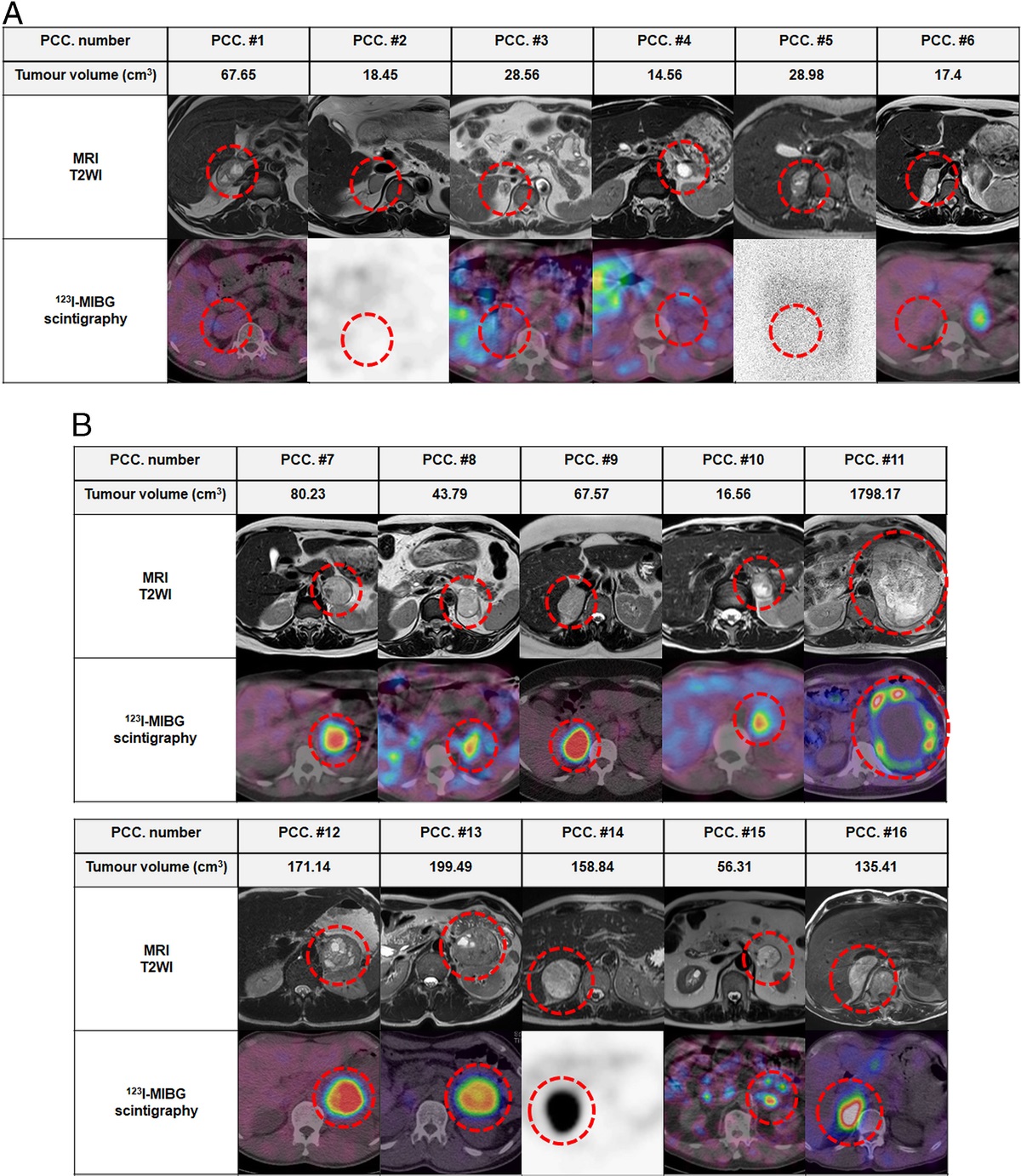 Increasing Catecholamine Secretion Through NPY in Pheochromocytomas With False-Negative 123I-MIBG Scintigraphy