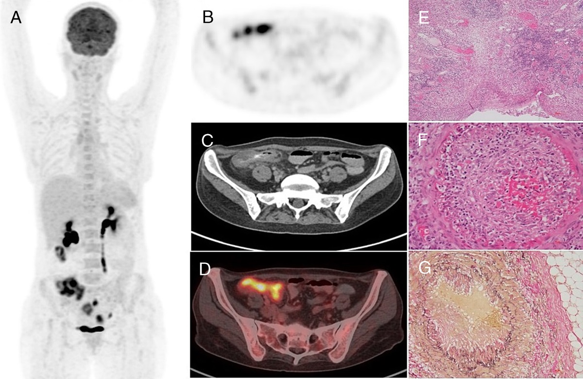 18F-FDG PET/CT in Lupus Enteritis Presenting With Fever and Abdominal Pain