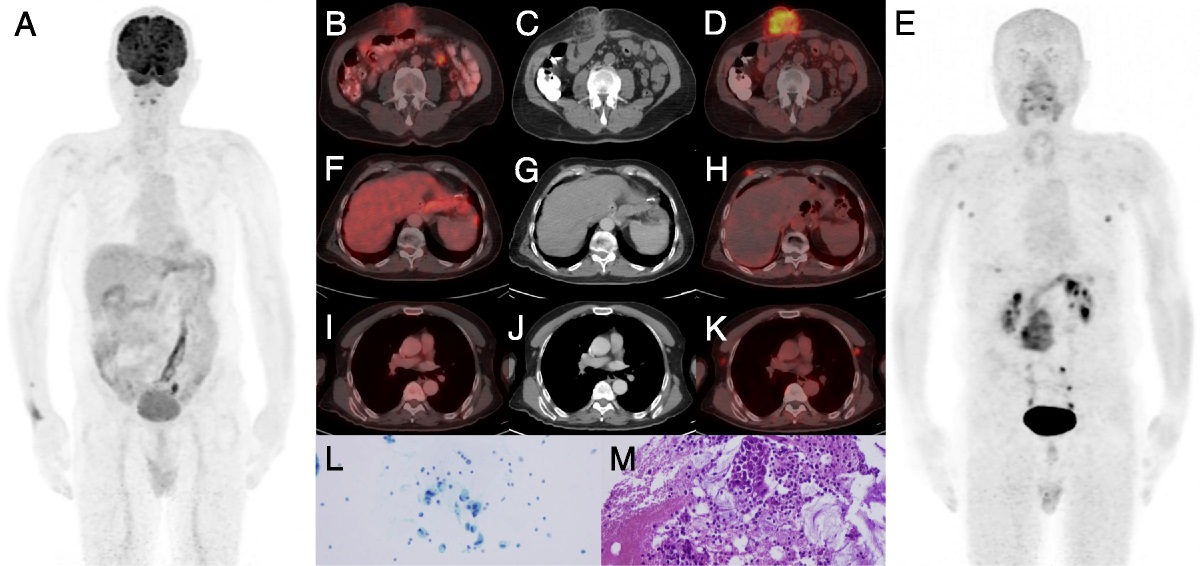 Unusual Metastasis of Signet-Ring Cell Gastric Cancer That Could Not Be Detected With 18F-FDG PET But With 68Ga-FAPI PET/CT