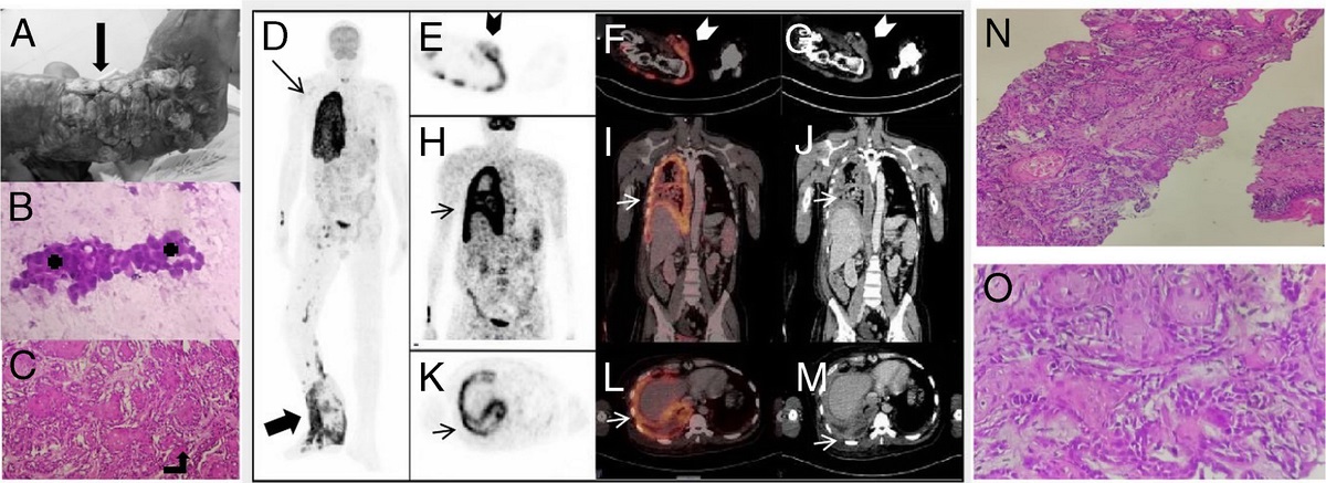 “Diffuse Hot Pleura” in a Case of Recurrent Squamous Cell Carcinoma of the Foot: 18: F-FDG PET/CT Findings