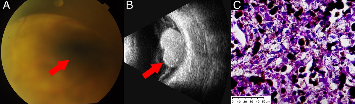 Comparison of 18F-AlF-NOTA-PRGD2 and 18F-FDG PET/CT Imaging in a Case of Primary Uveal Melanoma
