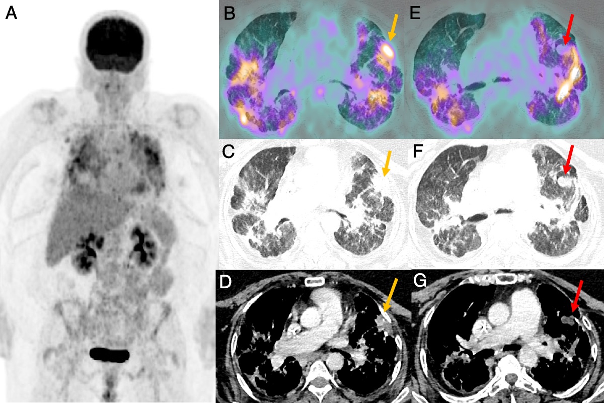 Pulmonary Recurrence of Colorectal Mucinous Adenocarcinoma and Sarcoidosis on 18F-FDG PET/CT