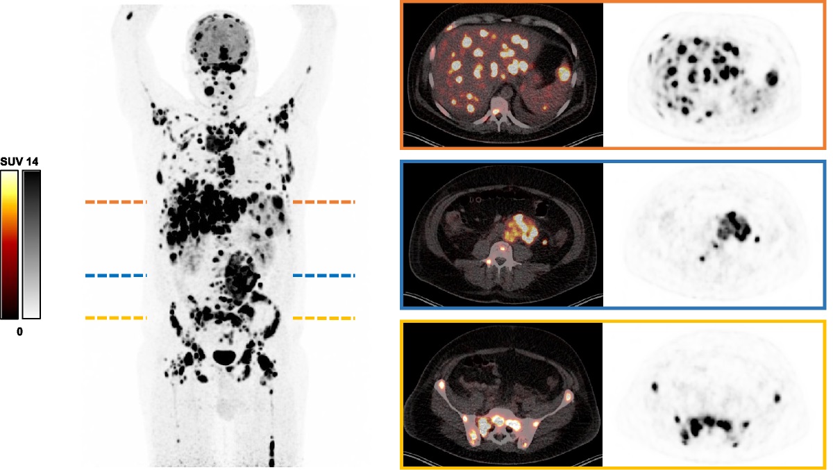 Mast Cell Sarcoma Mimicking Lymphoma or Metastatic Disease on 18F-FDG PET/CT