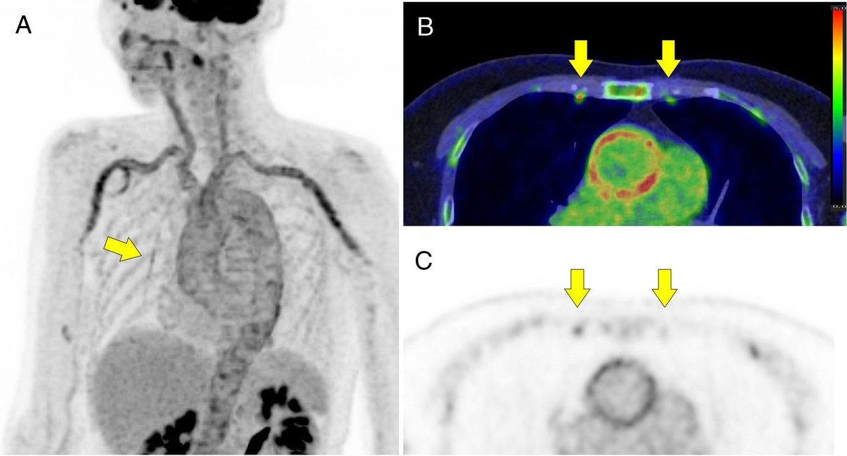 Visualization of the Internal Thoracic Arteries in Giant Cell Arteritis on 18F-FDG Semiconductor PET/CT