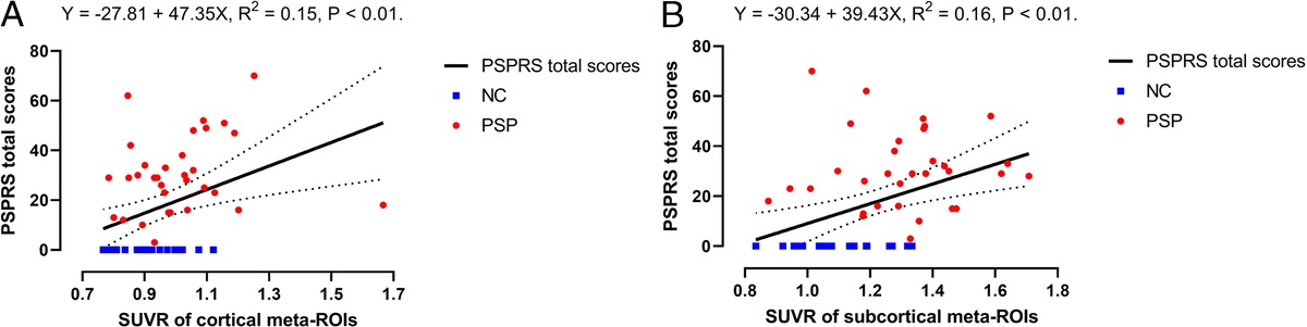 Dominance of Tau Burden in Cortical Over Subcortical Regions Mediates Glymphatic Activity and Clinical Severity in PSP