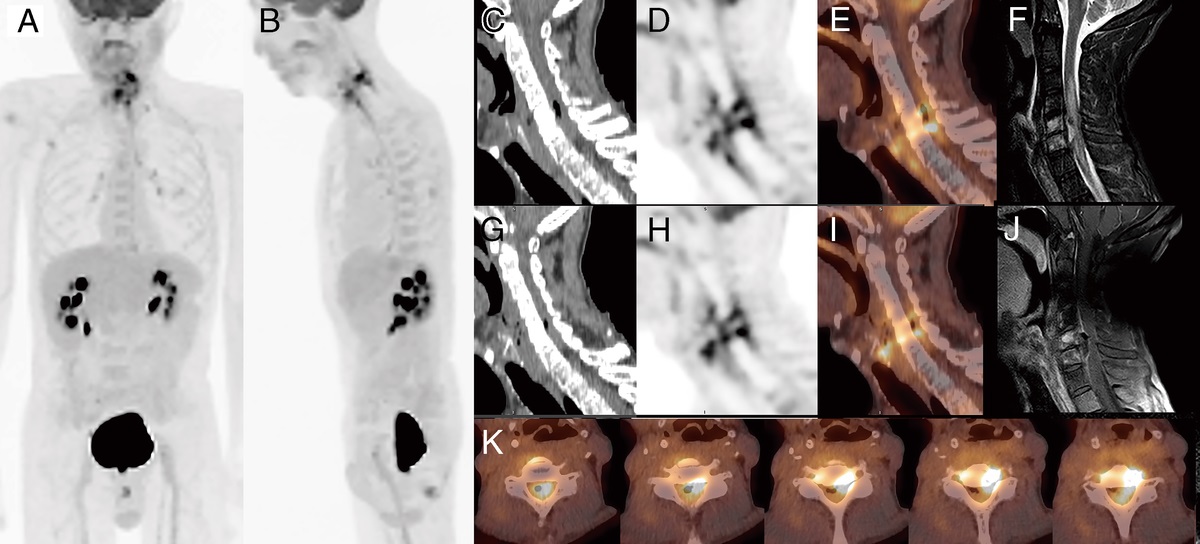 Pneumorrhachis With FDG Uptake Cervical Lesions on PET/CT of a Patient With Suspected Recurrent Hypopharyngeal Cancer