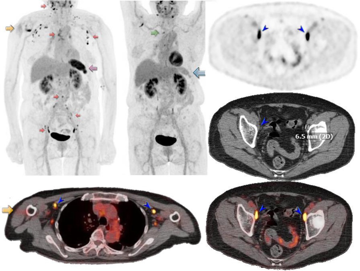 Widespread Reactive Lymphatic and Splenic FDG Avidity After mRNA COVID Vaccination