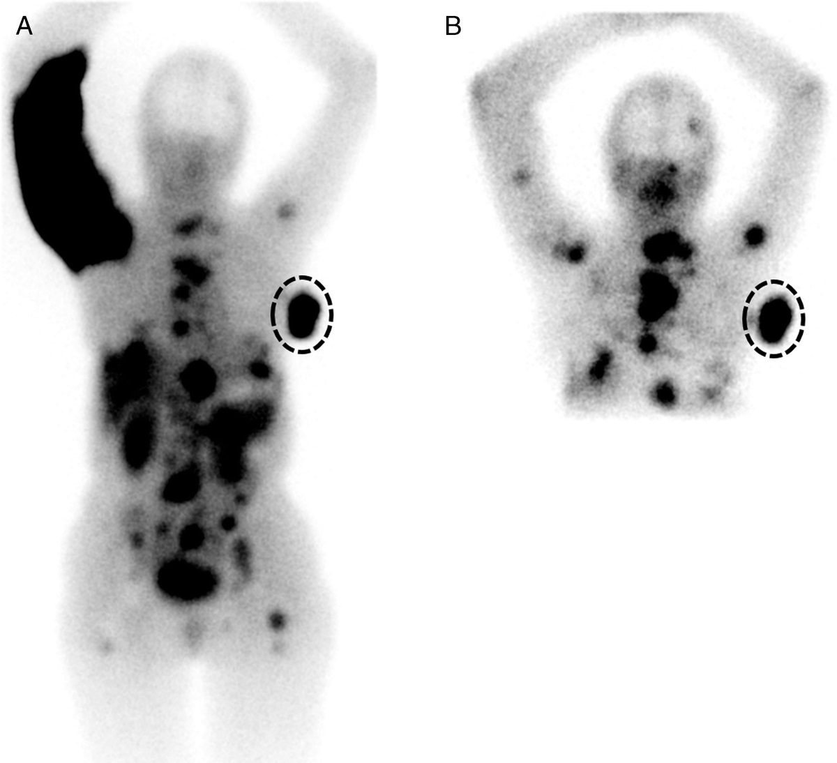 Extravasation After [177Lu]Lu-HA-DOTATATE Therapy
