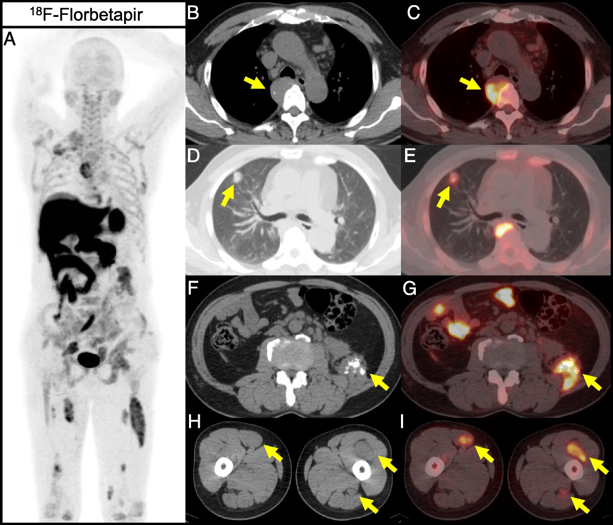 18F-Florbetapir PET/CT and 68Ga-FAPI PET/CT in a Case of Light Chain Amyloidosis With Predominant Multiple Tumor-Like Deposits