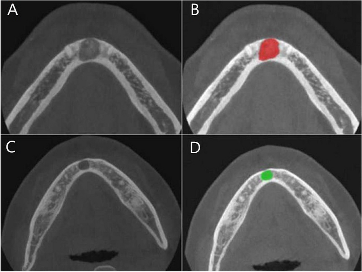 Differential diagnosis of cemento-osseous dysplasia and periapical cyst using texture analysis of CBCT