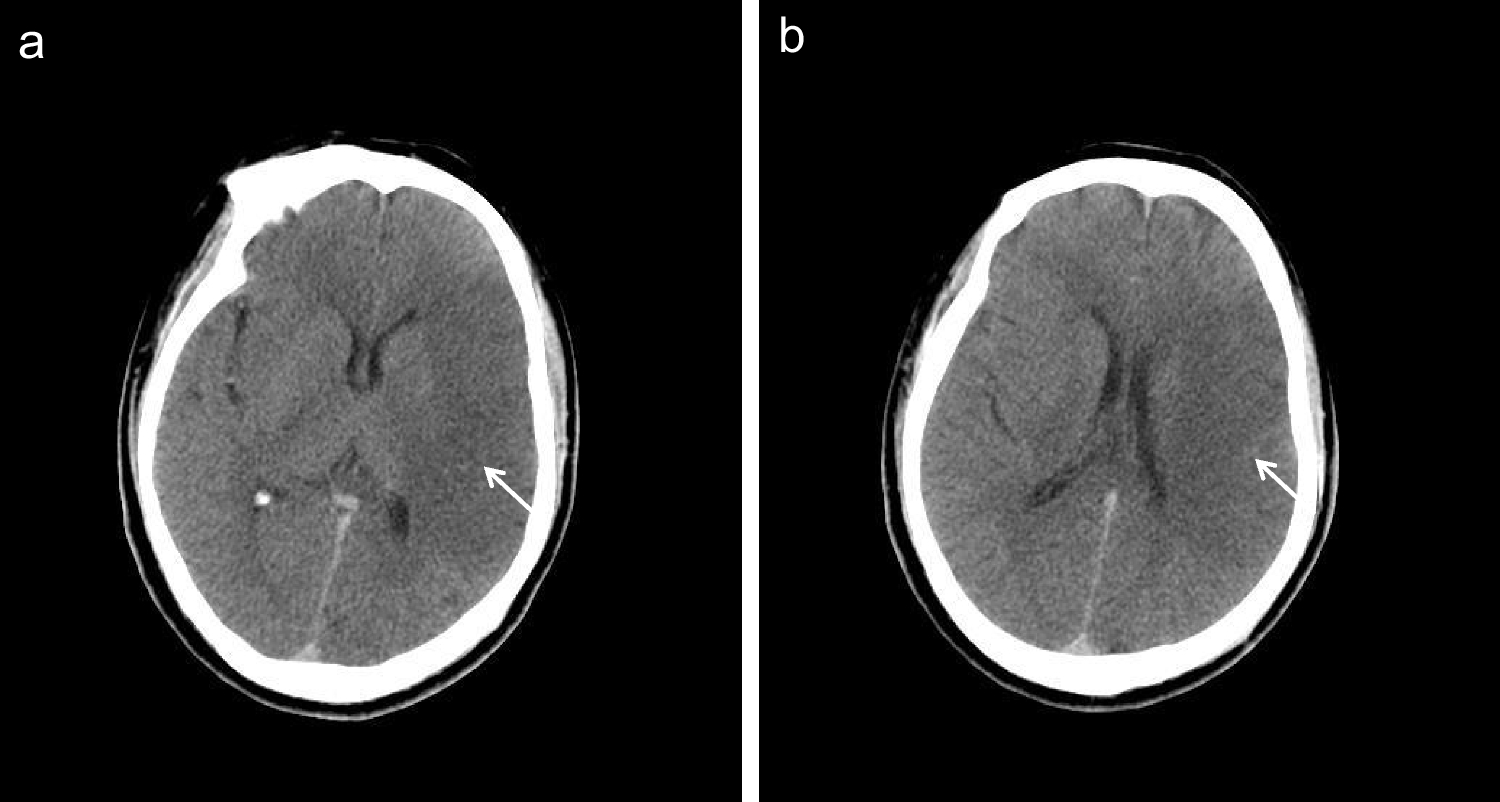 Efficacy of mechanical thrombectomy in the treatment of acute ischemic stroke patients with double aortic arches